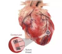 Forschungserfolg: Neuer Herzschrittmacher kann sich selbst auflösen